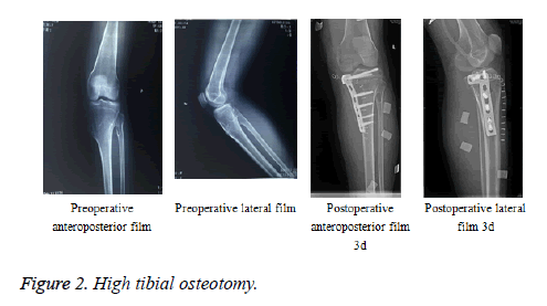 biomedres-High-tibial