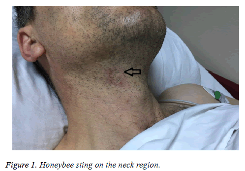 biomedres-Honeybee-sting