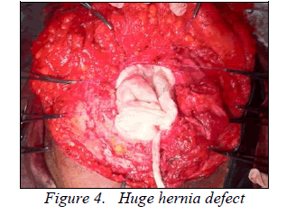 biomedres-Huge-hernia