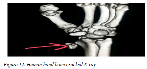 biomedres-Human-hand-bone