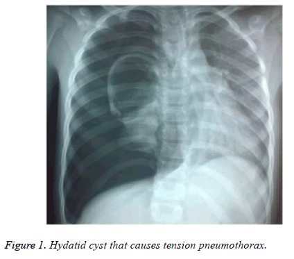 biomedres-Hydatid-cyst