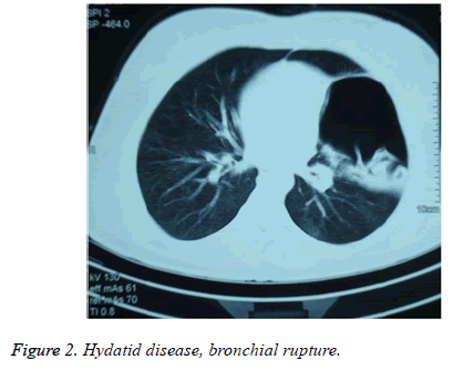 biomedres-Hydatid-disease