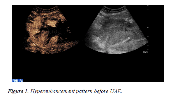 biomedres-Hyperenhancement-pattern