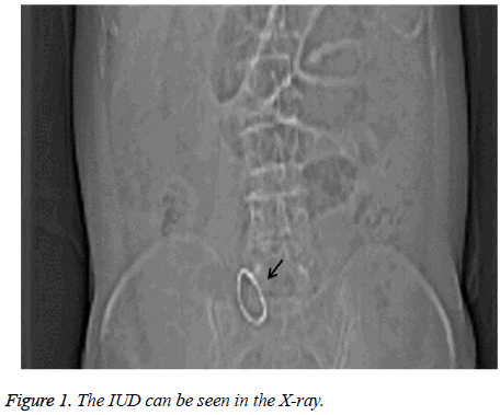 biomedres-IUD