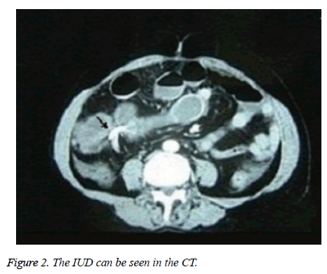 biomedres-IUD-CT