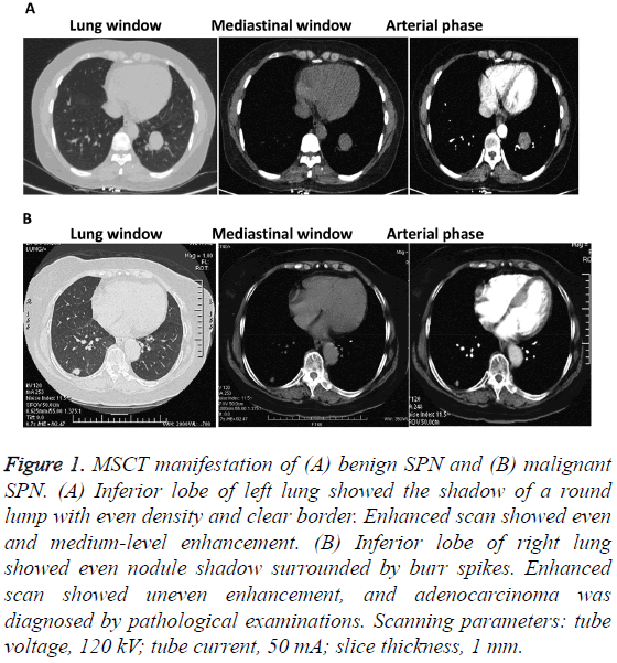 biomedres-Inferior-lobe-left-lung