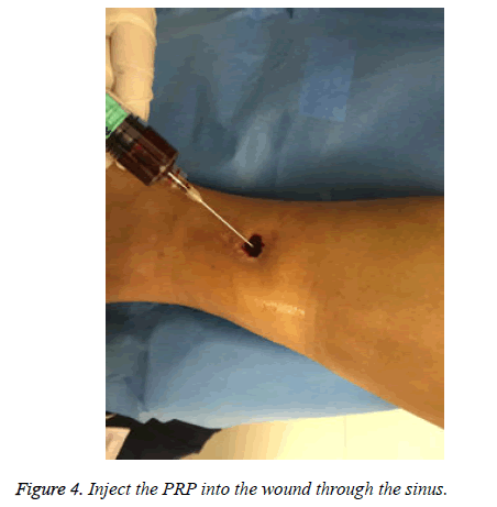 biomedres-Inject-PRP