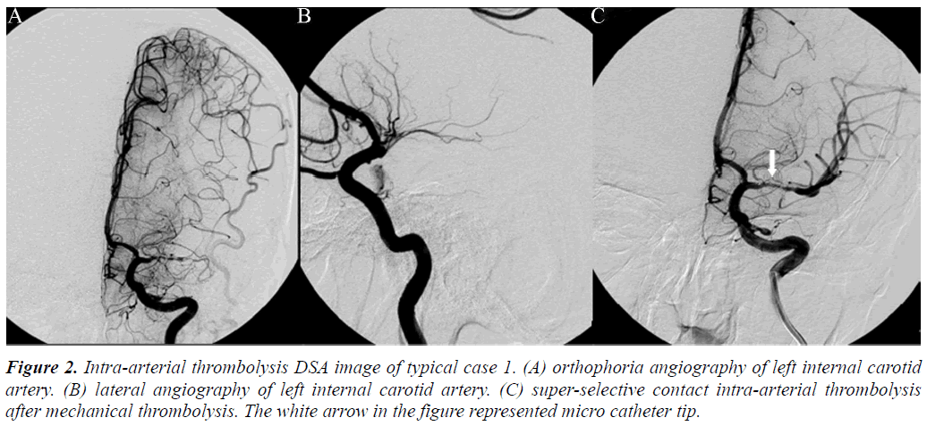 biomedres-Intra-arterial-thrombolysis