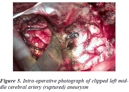 biomedres-Intra-operative-photograph