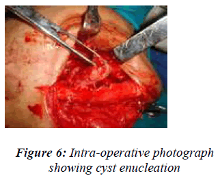 biomedres-Intra-operative-photograph-showing-cyst-enucleation