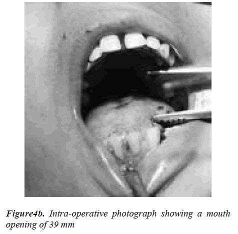 biomedres-Intra-operative-photograph-showing-mouth-opening