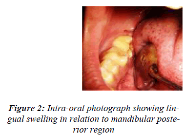 biomedres-Intra-oral-photograph-showing-lingual-swelling