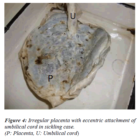 biomedres-Irregular-placenta-eccentric