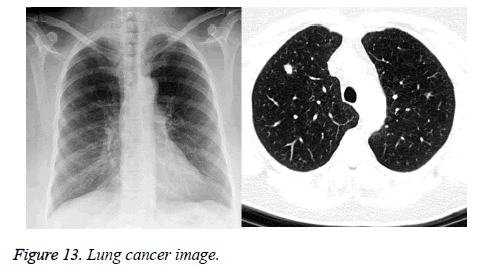 biomedres-Lung-cancer