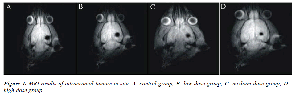 biomedres-MRI-results-intracranial-tumors