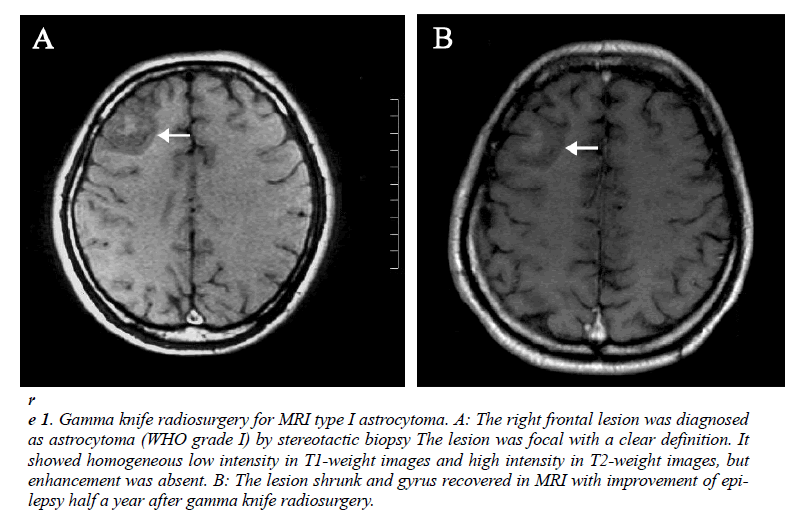 biomedres-MRI-type-I-astrocytoma