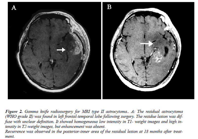 biomedres-MRI-type-II-astrocytoma