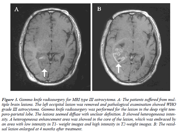 biomedres-MRI-type-III-astrocytoma