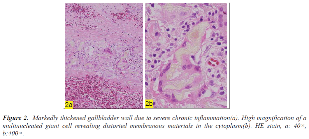 biomedres-Markedly-thickened-gallbladder