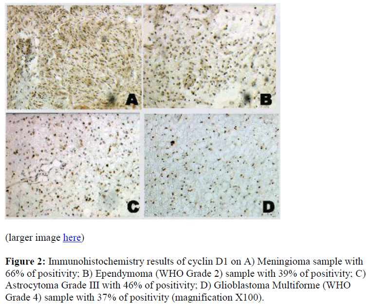 biomedres-Meningioma-Ependymoma-Glioblastoma-Multiforme