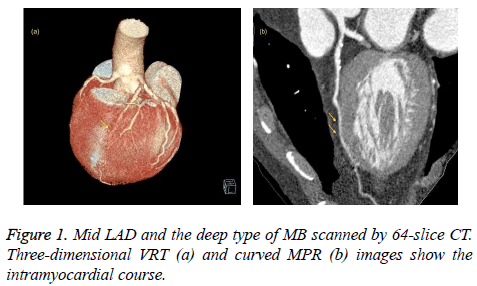 Mid-LAD-intramyocardial