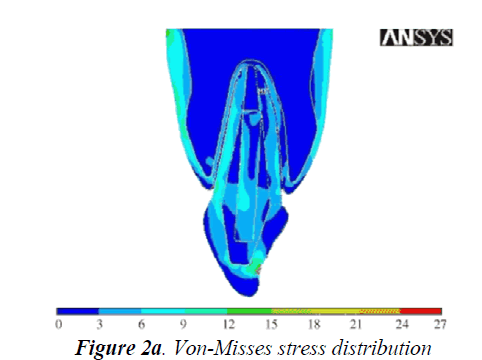 biomedres-Misses-stress-distribution