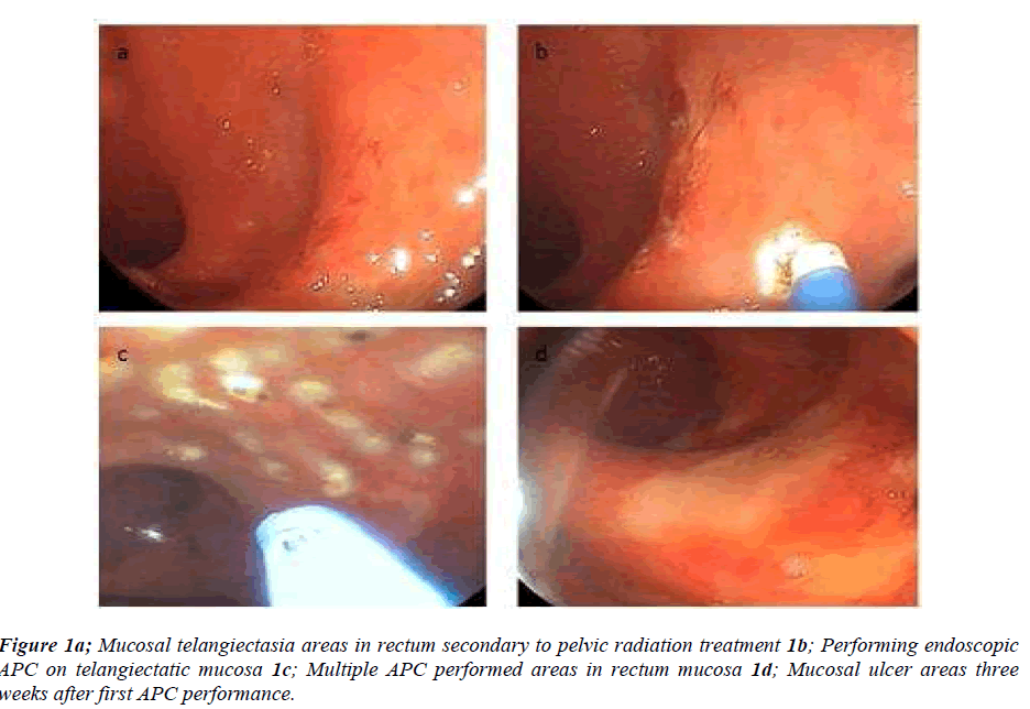 biomedres-Mucosal-telangiectasia-areas