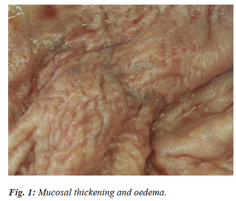 biomedres-Mucosal-thickening