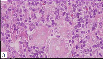 biomedres-Multinucleated-macrophages