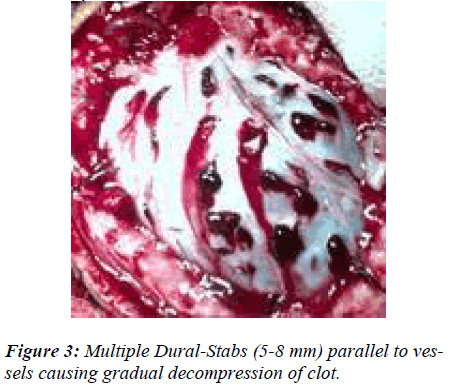 biomedres-Multiple-Dural-Stabs