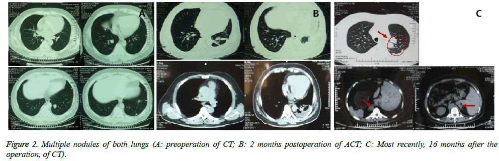 biomedres-Multiple-nodules