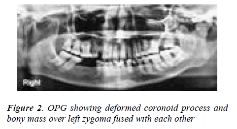 biomedres-OPG-showing-deformed-coronoid-process