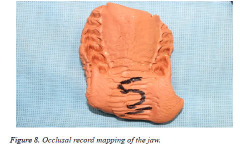 biomedres-Occlusal-record