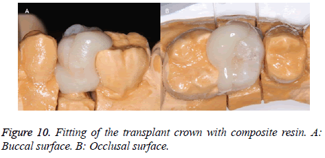 biomedres-Occlusal-surface