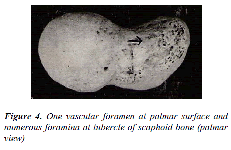 biomedres-One-vascular-foramen-palmar-surface