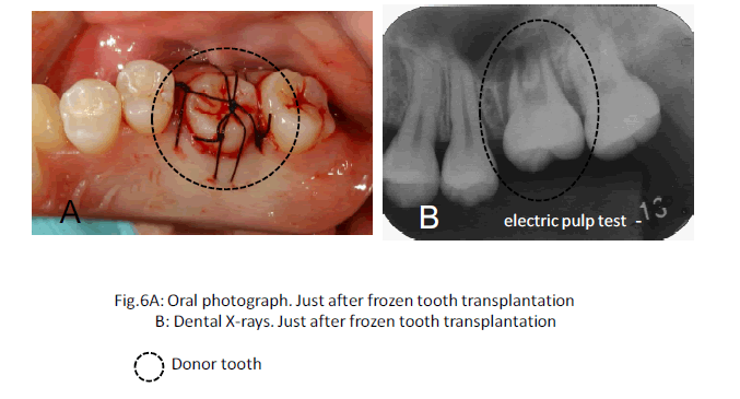 biomedres-Oral-photograph-transplantation