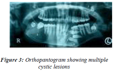 biomedres-Orthopantogram-showing-multiple-cystic-lesions
