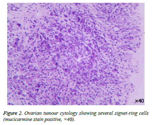 biomedres-Ovarian-tumour