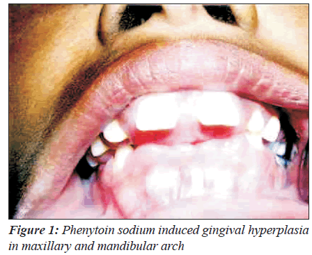 biomedres-Phenytoin-sodium-induced-gingival-hyperplasia