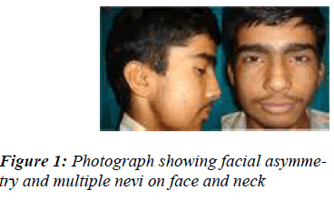 biomedres-Photograph-showing-facial-asymmetry