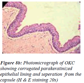 biomedres-Photomicrograph-OKC-showing-corrugated-parakeratinized