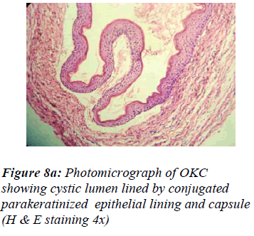 biomedres-Photomicrograph-OKC-showing-cystic-lumen