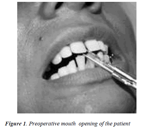 biomedres-Preoperative-mouth-opening-patient