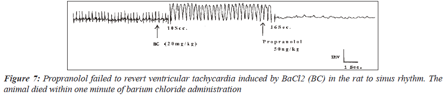 biomedres-Propranolol-failed-revert-ventricular-tachycardia