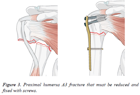 biomedres-Proximal-humerus