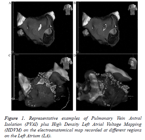 biomedres-Pulmonary-Vein