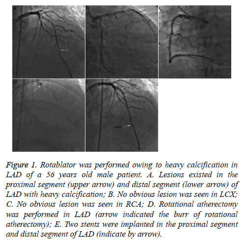 biomedres-Rotablator-performed