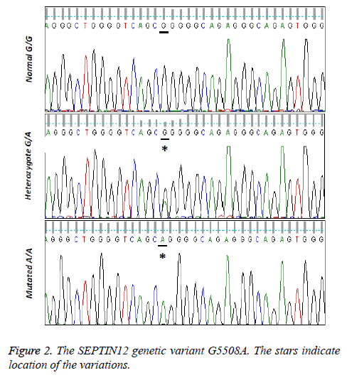 biomedres-SEPTIN12-genetic-variant