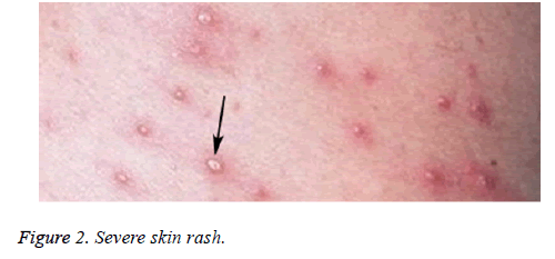 biomedres-Severe-skin-rash
