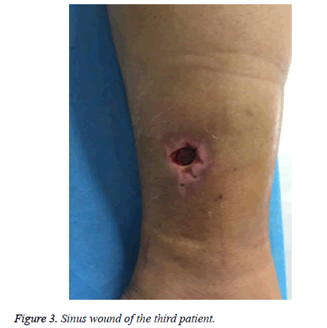 biomedres-Sinus-wound